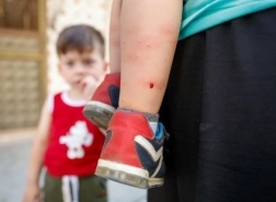 تحذير لسكان اسطنبول.. البعوض يهاجم أجساد الأطفال بشراسة (صور)