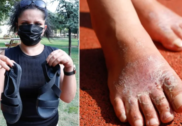 سيدة تركية تصاب بعدوى في قدميها بعد يوم واحد من ارتداء حذاء رخيص الثمن