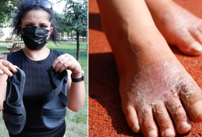 سيدة تركية تصاب بعدوى في قدميها بعد يوم واحد من ارتداء حذاء رخيص الثمن