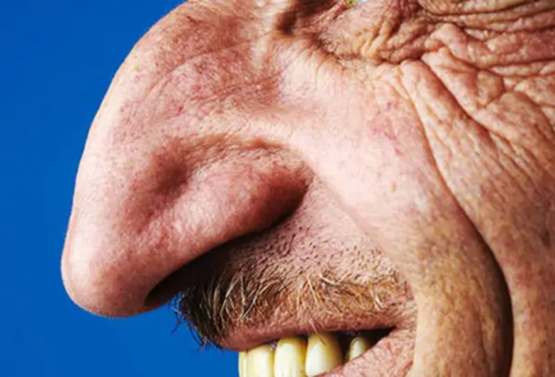 التركي محمد أوزيوريك لديه أكبر أنف في العالم لشخص حي
